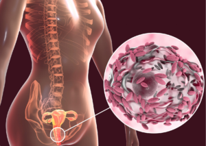 Estudio vaginosis-Pamplona